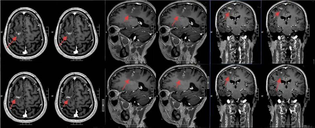 怎么申请皇冠信用网_广东一男子20多年不敢一个人出门怎么申请皇冠信用网，医生从他脑中取出10厘米活虫